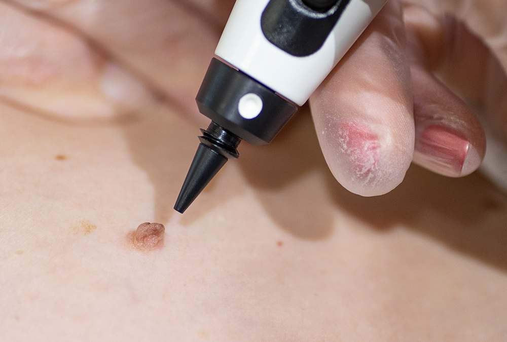 Dermatology treatment being performed on a patient's skin in a professional clinic setting